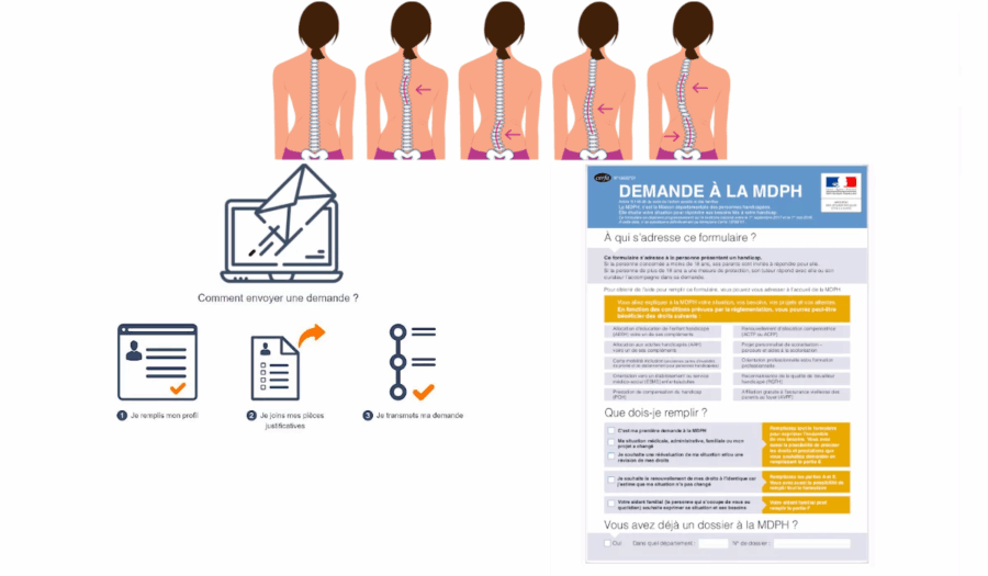 dossier mdph scoliose grave